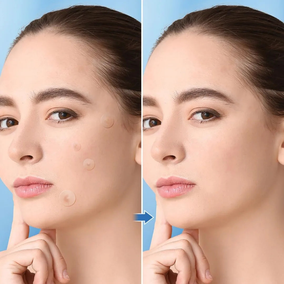 Acne Patches 1200pcs
